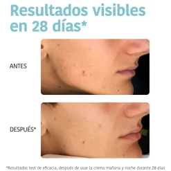*Acne Prone Skin* - Crema facial Oil Control - Pieles acnéicas