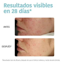 *Acne Prone Skin* - Discos tónico exfoliantes - Pieles acnéicas