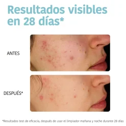 *Acne Prone Skin* - Limpiador purificante - Pieles acnéicas