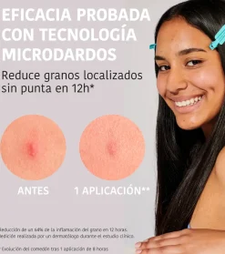 *Acne Prone Skin* - Parches para granos con ácido salicílico Microdarts