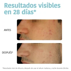 *Acne Prone Skin* - Sérum facial Prevent & Correct - Pieles acnéicas