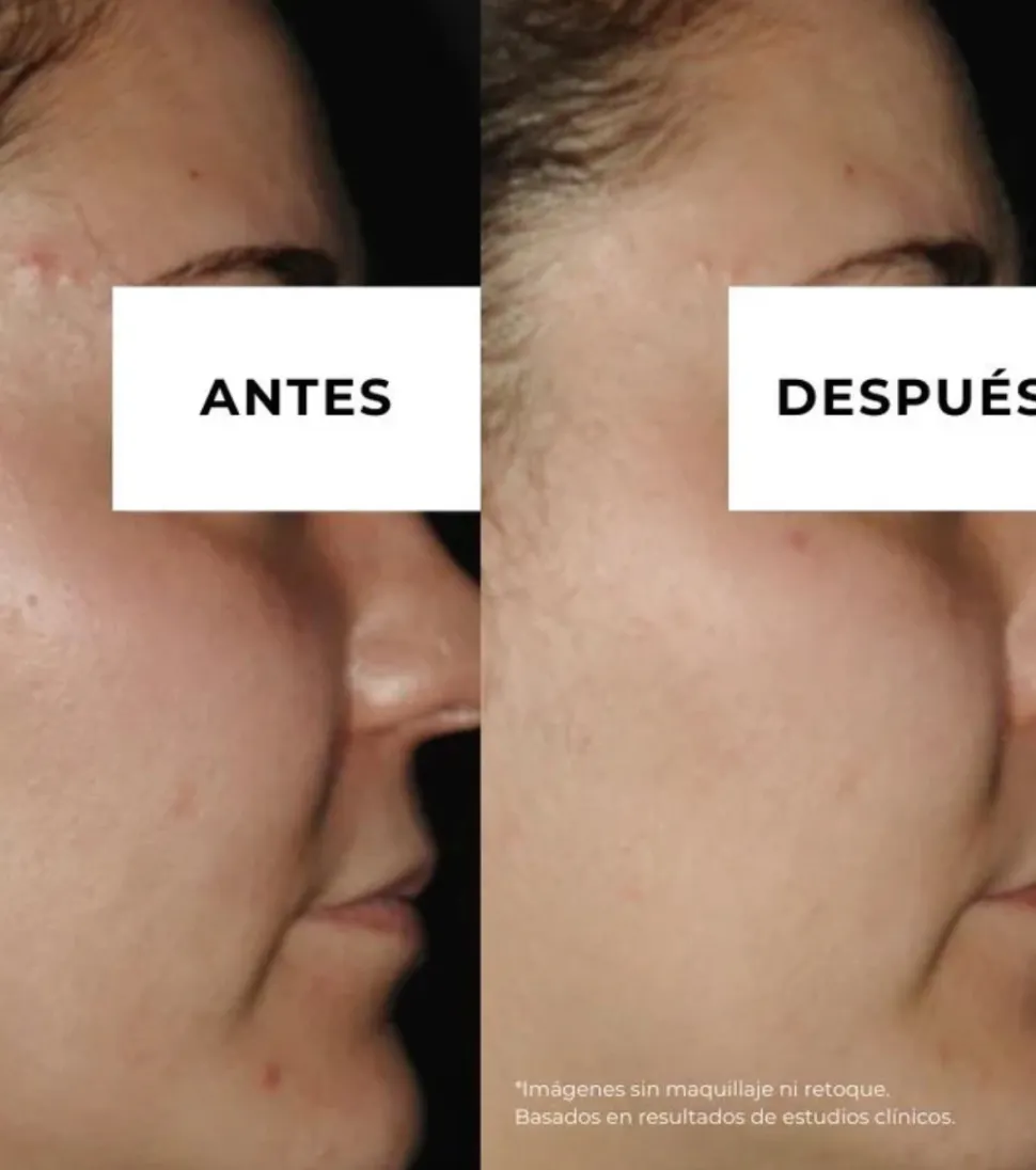 Crema antiacné reductor de marcas Equilibrium - Pieles grasas con tendencia acneica