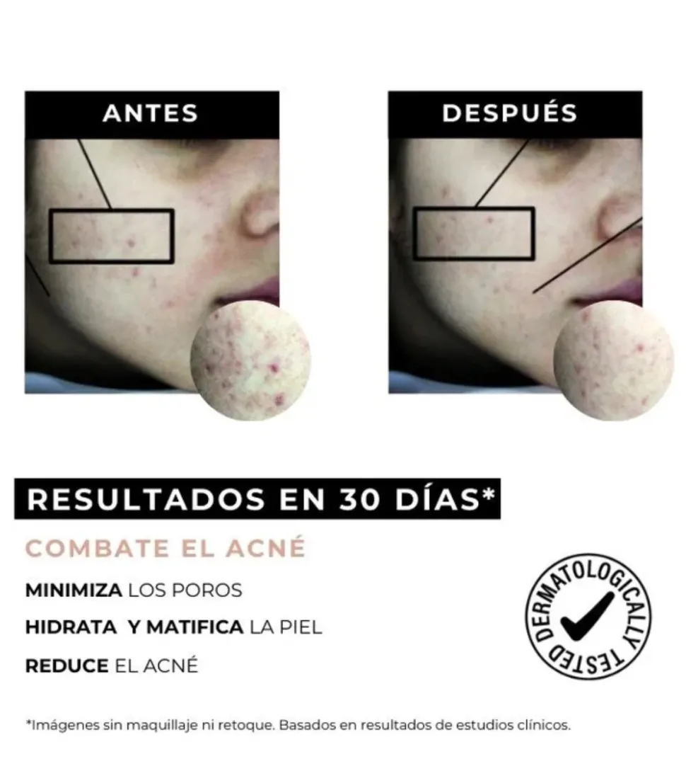 Crema antiacné reductor de marcas Equilibrium - Pieles grasas con tendencia acneica