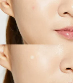 Parches para imperfecciones Acne Pimple Master Patch