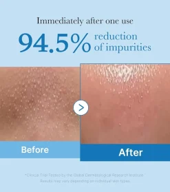 *Zero Pore* - Aceite limpiador Blackhead Deep
